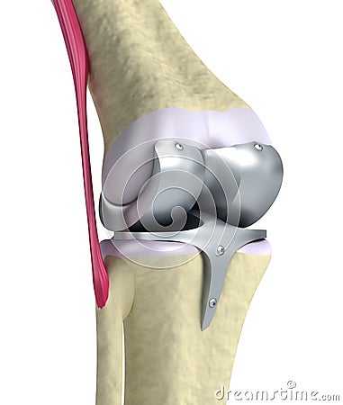 Knee and titanium hinge joint Stock Photo