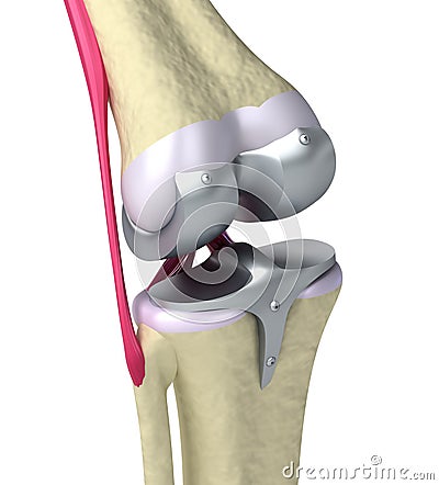 Knee and titanium hinge joint Stock Photo