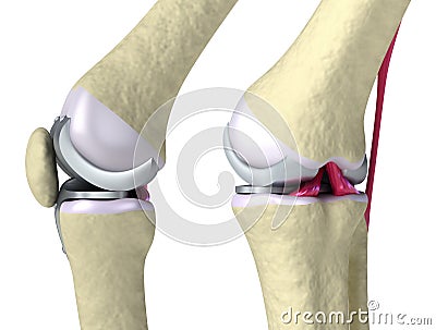 Knee and titanium hinge joint Stock Photo