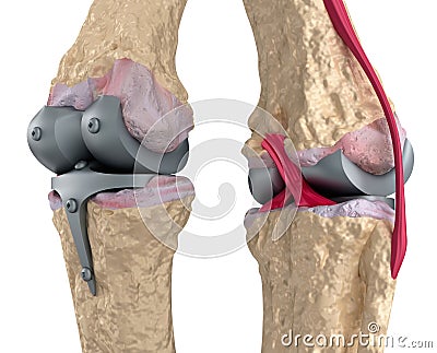 Knee and titanium hinge joint. Stock Photo