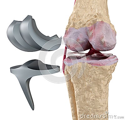 Knee and titanium hinge joint. Isolated Stock Photo