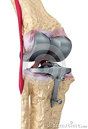 Knee and titanium hinge joint. Isolated Stock Photo