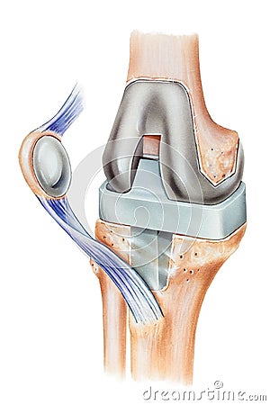 Knee -Total Replacement Stock Photo