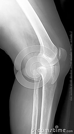 Knee x-ray Stock Photo