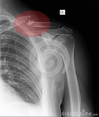 Knee x-rays image showing plate and fixation Stock Photo