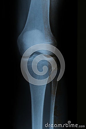 Knee Xray with 4 visible bones Stock Photo