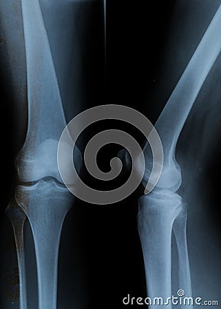 Knee Xray with 4 visible bones Stock Photo