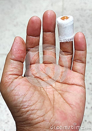 The knife cut off left ring finger, laceration wound , accident at home. Stock Photo