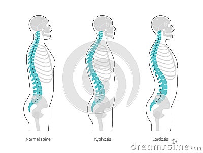 Kyphosis, lordosis flat vector illustration. Vector Illustration