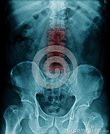 L-spondylosis Stock Photo