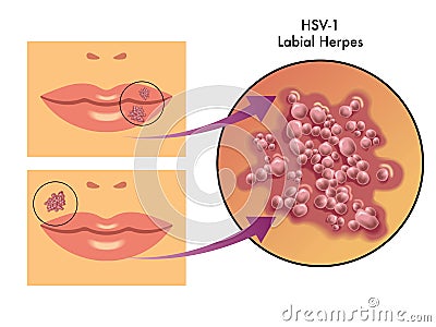 Labial herpes Vector Illustration