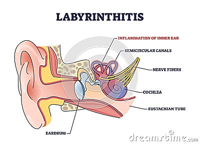 Labyrinthitis as inner ear infection and medical inflammation outline diagram Vector Illustration