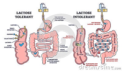 Lactose intolerance and tolerance medical process differences outline diagram Vector Illustration