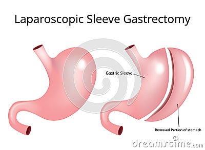 Laparoscopic Sleeve Gastrectomy / Weight loss surgery - Vector Stock Photo