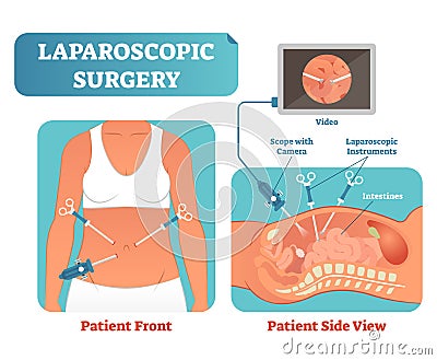 Laparoscopic surgery medical health care surgical procedure process, anatomical cross section vector illustration diagram. Vector Illustration