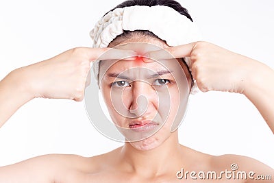 Large acne, pimple or blemishes on beauty girl face. Beautiful young asia woman popping inflammation acne or pustules pimple. Acne Stock Photo