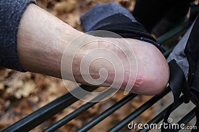 Large blister on the heel Stock Photo