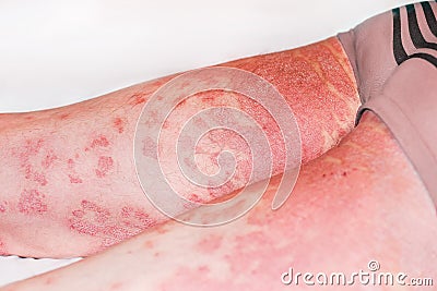 Large inflamed,scaly rash on man's legs.Acute psoriasis, severe reddening of the skin,an autoimmune,incurable Stock Photo