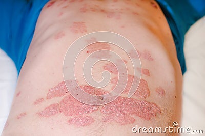 Large red inflamed scaly rash on the stomach. Acute psoriasis on the stomach in a man, severe redness on the skin, an Stock Photo