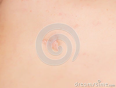 Large scar and scar on the patient`s skin after removing an inflamed pimple, close-up, professional Stock Photo