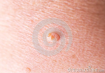 Large wart on the skin of a person, background, macro, dermatology Stock Photo