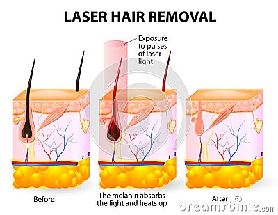 Laser hair removal. Vector diagram Vector Illustration