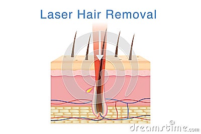 Laser light for hair removal on skin layer. Vector Illustration