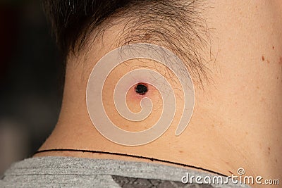Laser mole removal. trace from the procedure. Scar on the second knock after burning papillomas with a laser. Burn mark Stock Photo