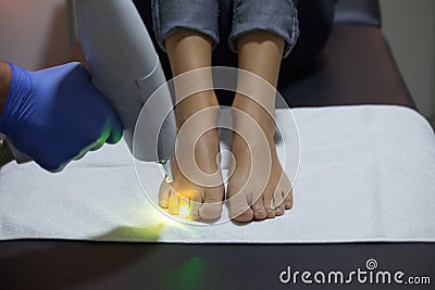 Laser nail fungus treatment Stock Photo