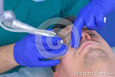 Laser removal of papillomas on man eye skin, surgeon make surgery, face closeup. Stock Photo