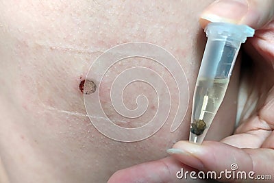 Laser removal of skin lesions. Stock Photo