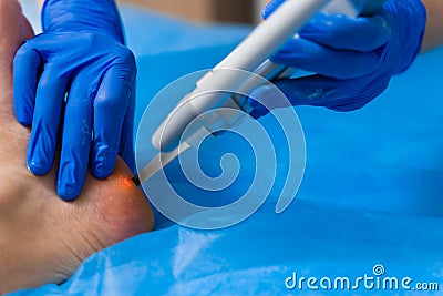 Laser removal of warts on the foot. Medical dermatological surgery in the clinic Stock Photo