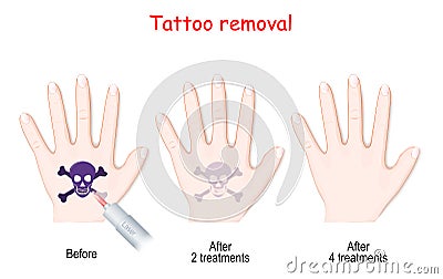 Laser tattoo removal Vector Illustration