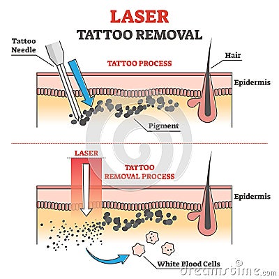 Laser tattoo removal process labeled educational explanation outline concept Vector Illustration