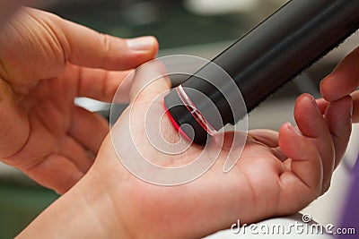 Laser therapy to the thumb. Stock Photo