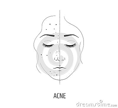 Laser treatment of acne. The effect of cosmetology procedures. Cosmetic facial care product. Before and after Vector Illustration