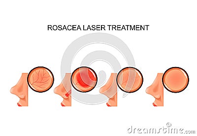 Laser treatment of rosacea Vector Illustration