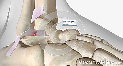 Lateral Ankle Sprain Torn Anterior Talofibular Ligament Stock Photo