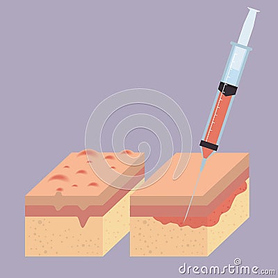 Layers of skin with botox injection Vector Illustration