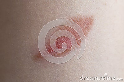 Leaf shaped burn wound on a woman's fore arm, macro skin texture Stock Photo