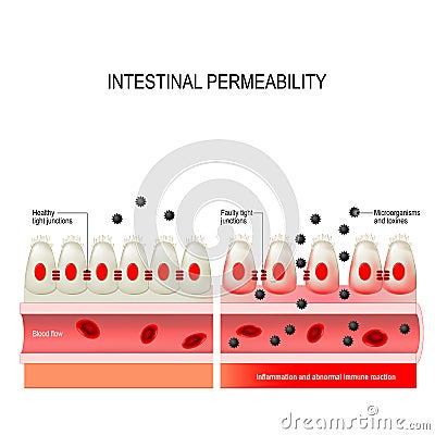 Leaky gut. Intestinal permeability Vector Illustration