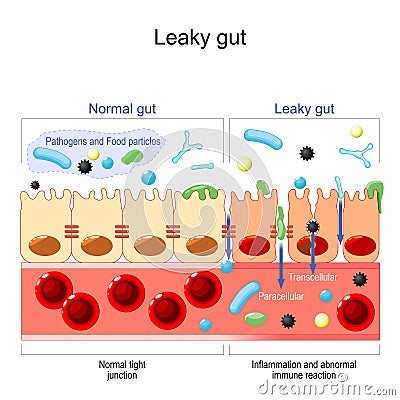 Leaky gut Vector Illustration