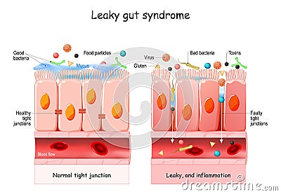 Leaky gut Syndrome Vector Illustration