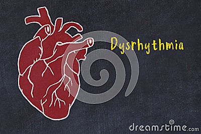 Chalk sketch of human heart on black desc and inscription Dysrhythmia Stock Photo