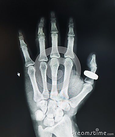Left hand X-Ray 4th finger broken Stock Photo