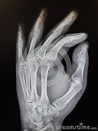 Left hand X-Ray 4th finger broken Stock Photo