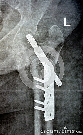 Left hip trans cervical neck of femur fracture fixated by DHS Dynamic Hip Screw, Plain x ray PXR of an old patient, a femoral head Stock Photo