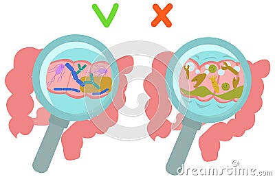 On the left is intestine with normal microflora, on the right is a poor composition of microflora with pathogenic Vector Illustration