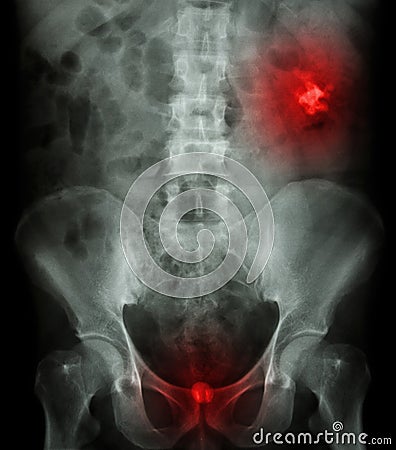 Left kidney stone(opaque area at right upper of image) and bladder stone(opaque area at lower of image ) Stock Photo