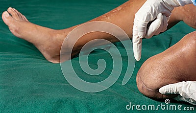 Leg amputee Stock Photo